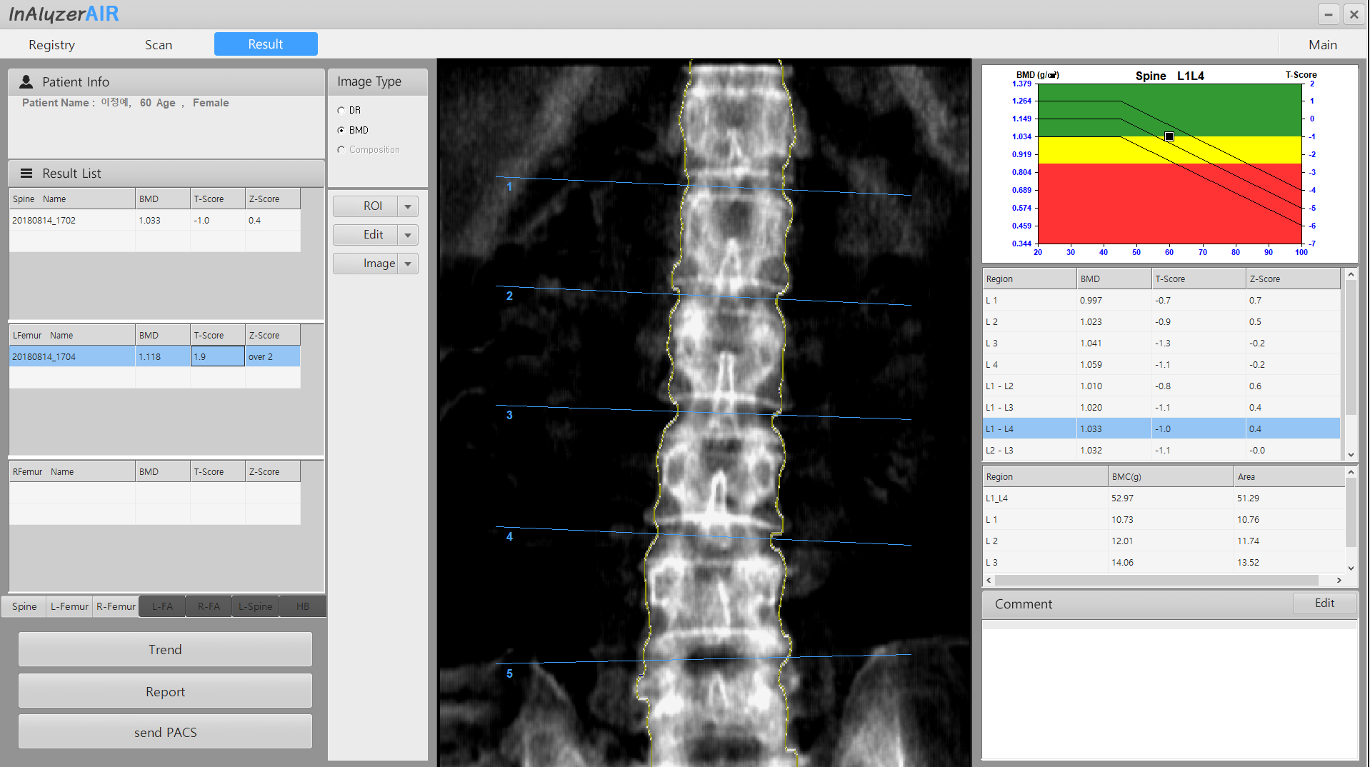 Bone Densitometer